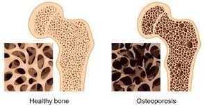osteoporose óssea